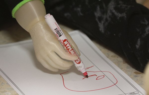 A picture taken on January 16th shows a 3-year-old child using her new 3D-printed prosthetic arm at the Doctors Without Borders reconstructive surgery hospital in Amman. [Khalil Mazraawi/AFP]