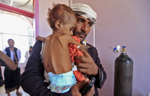 In this file photo taken on October 6th, a Yemeni man carries his child, who is suffering from malnutrition, into a treatment centre at a hospital in Sanaa. [Mohammed Huwais/AFP]