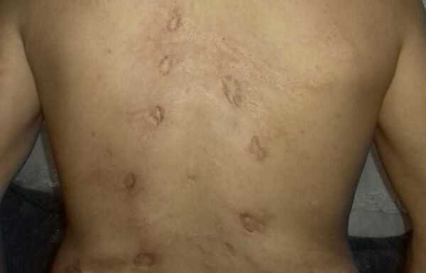Syrian refugee Ahmed Ibrahim returned to his home in the city of Hama only to be arrested and tortured by Syrian regime forces, who drilled holes in his back. [Photo courtesy of Ahmed Ibrahim]