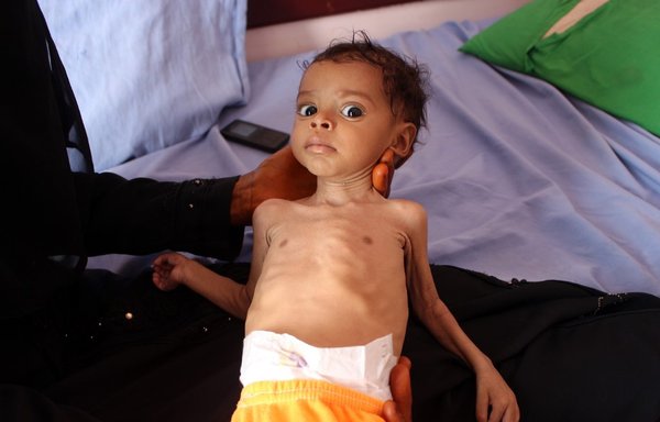 In this file photo taken on November 3rd, 2019 a malnourished Yemeni toddler is held by a woman at a clinic run by a humanitarian organisation in the port city of al-Hodeidah. [Essa Ahmed/AFP]