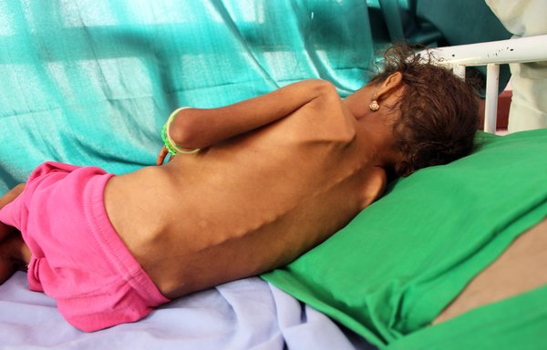 A Yemeni girl suffering from malnutrition lies on a bed at a clinic in Yemen's northern Hajjah province in early 2020. [ESSA AHMED / AFP]