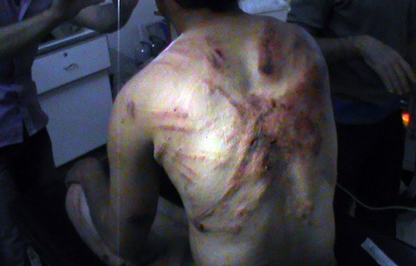 A Syrian man shows his injured back in the city of Rastan, north of Homs on April 27, 2012, claiming that he was tortured by regime forces. [AFP Photo/STR]