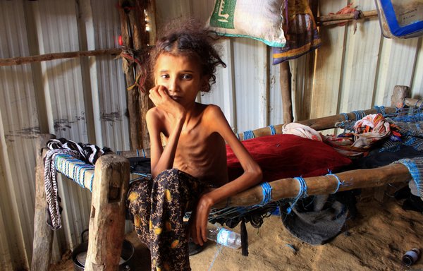 Yemeni 10-year-old girl Ahmadia Abdo, who weighs 10kg because of acute malnutrition, sits on her bed at a camp for the internally displaced in Hajjah province on January 23. [Essa Ahmed/AFP]