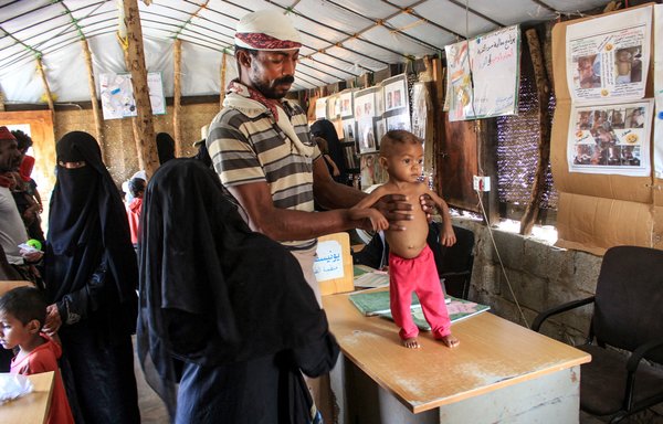 الطفلة اليمنية رندا علي البالغة من العمر 3 سنوات والتي تعاني من سوء تغذية حاد، ويساعدها والدها في عيادة بمخيم الخديش للنازحين في مديرية عبس بمحافظة حجة شمالي غربي اليمن في 19 شباط/فبراير. [عيسى أحمد/وكالة الصحافة الفرنسية]