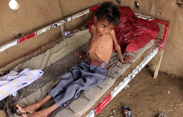 Hassan Razem, a 10-year-old child suffering from acute malnutrition, is pictured in Abs district, Hajjah province, on July 25. [Essa Ahmed/AFP]